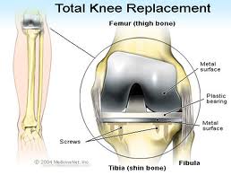Total Knee Replacement | 👨‍⚕️Singapore Orthopaedic & Neurosurgery Clinic