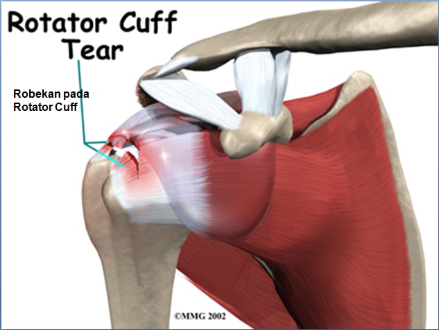 Torn Rotator Cuff Anatomy