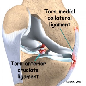 Medial Collateral Ligament Sprain | 👨‍⚕️Singapore Orthopaedic ...