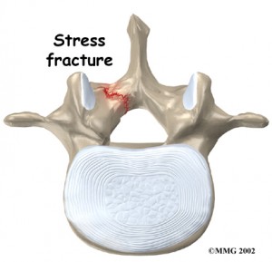 Stress Fracture of the Vertebrae | 👨‍⚕️Singapore Orthopaedic ...