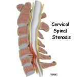 Cervical Spinal Stenosis Specialist | Singapore Spine Surgeon